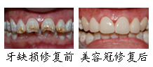 郑州唯美牙齿缺损案例