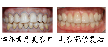 郑州唯美美容冠四环素牙案例