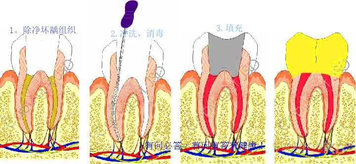 做一次根管治疗需要多少时间