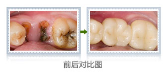 修补一颗蛀牙大概要多少钱