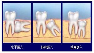 口腔里有个智齿怎么办