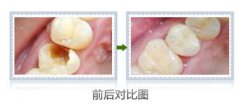 一般修补牙齿得多长时间