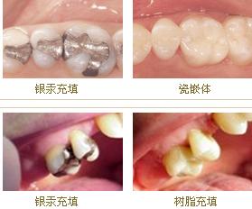 2015年补牙多少钱一颗