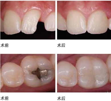 补牙需要去几次